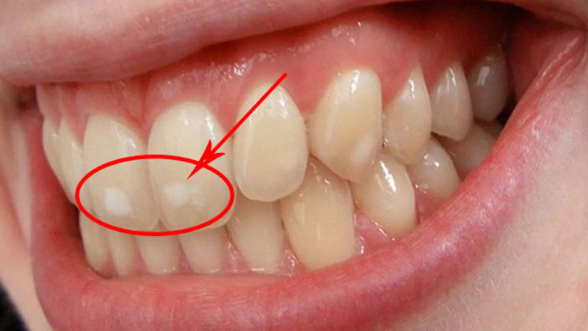 Cảnh giác với Fluoride trong nước: Khi tác dụng phụ vượt xa lợi ích Lượng fluoride trong nước quá cao có thể gây hại đến răng